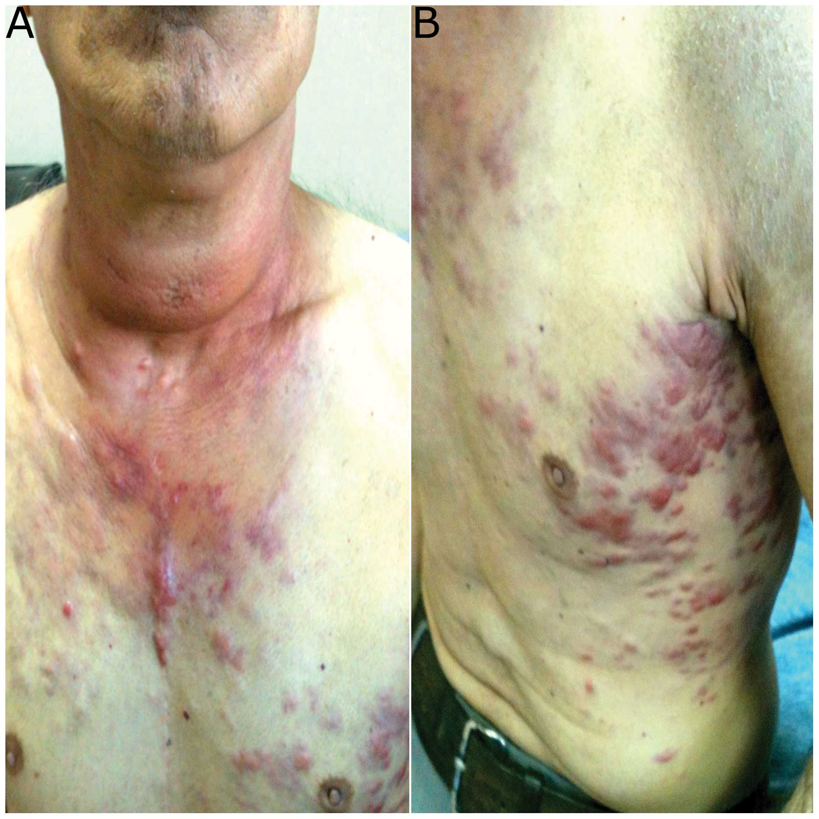 Anaplastic thyroid carcinoma with diffuse thoracic skin metastasis: A ...