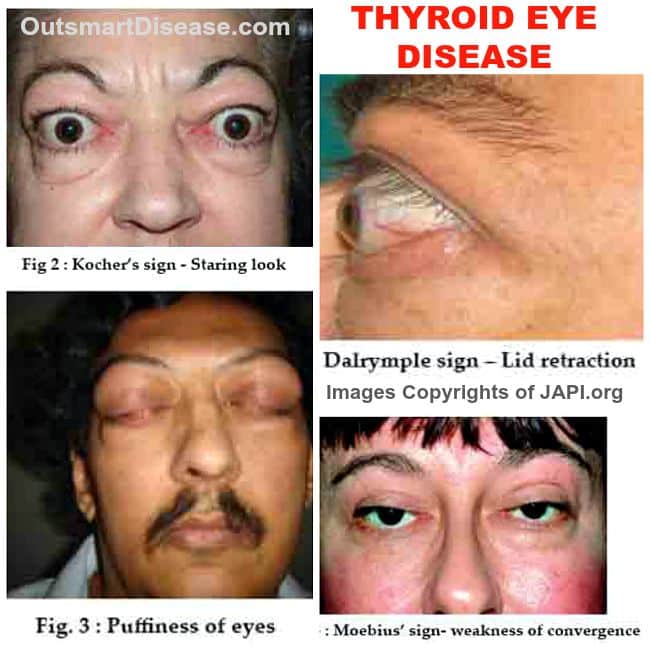 Are you at risk for thyroid eye disease?