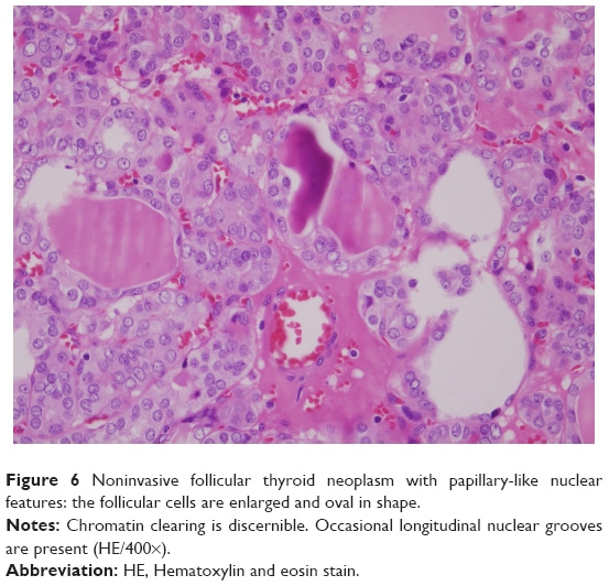BRAF mutation in cytologically indeterminate thyroid nodules: after re ...