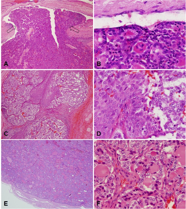 BRAF mutations in thyroid tumors from an ethnically diverse group ...