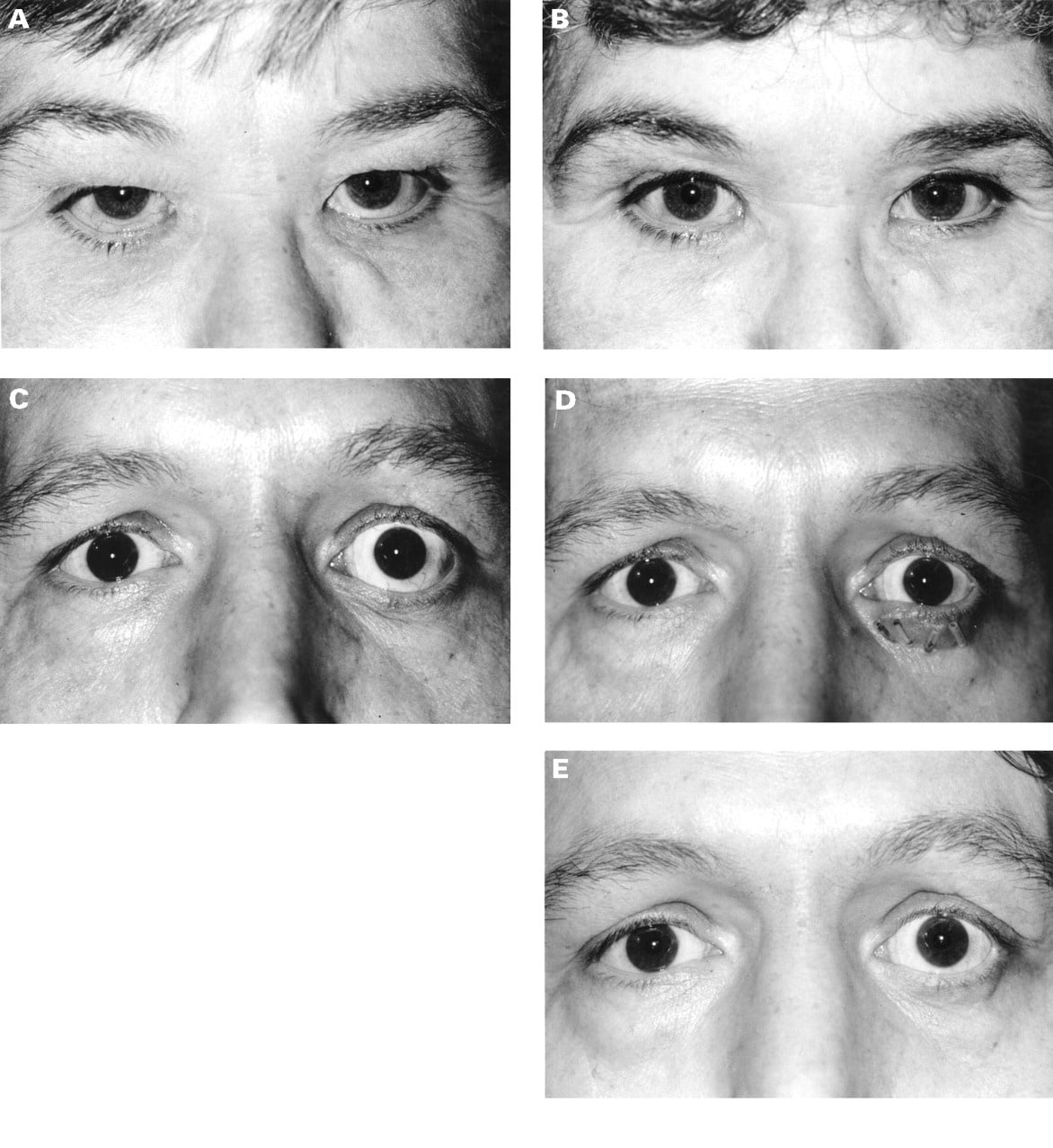 Correction of lower eyelid retraction in thyroid eye disease: a ...