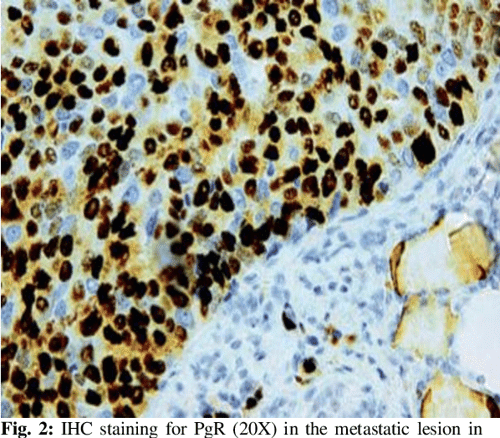 Figure 2 from Thyroid Gland Metastasis from Breast Cancer as Sixth Site ...