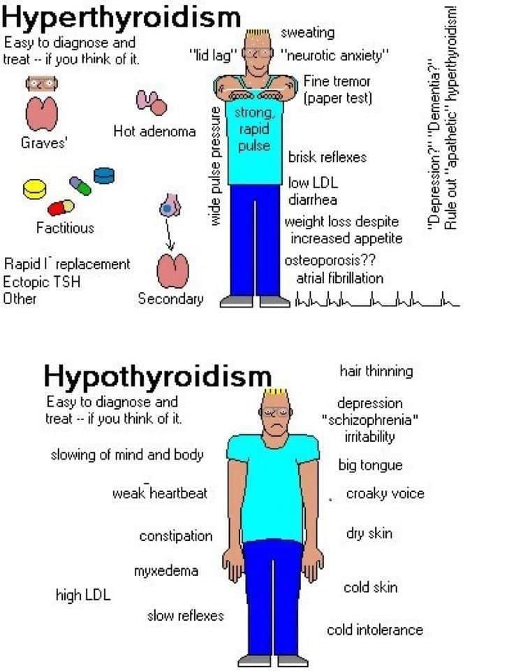 Hyperthyroidism is characterized by hypermetabolism and elevated serum ...