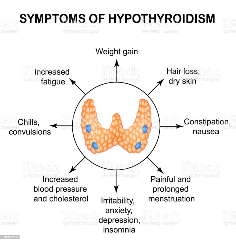 Symptoms Of Hypothyroidism Thyroid Infographics Vector Illustration On ...