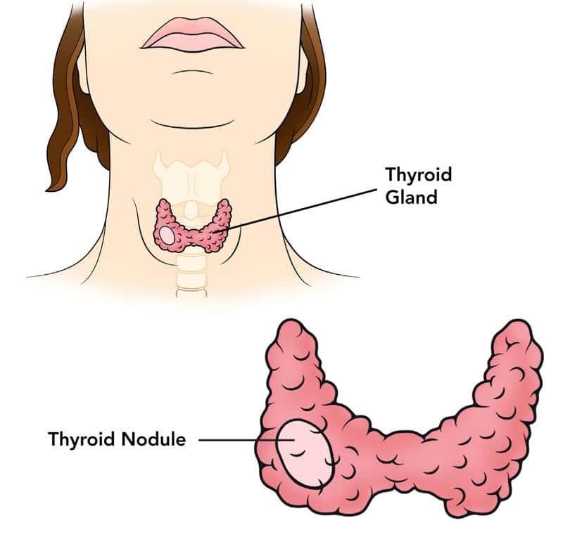 Types of thyroid cancer